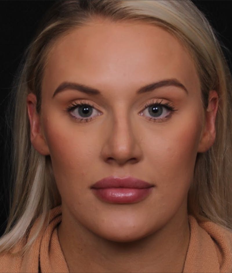 Rhinoplasty Female Before & After Gallery - Patient 194684 - Image 3