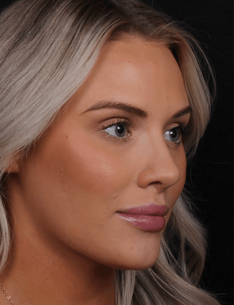 Rhinoplasty Female Before & After Gallery - Patient 194684 - Image 10