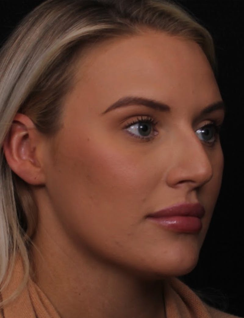 Rhinoplasty Female Before & After Gallery - Patient 194684 - Image 9