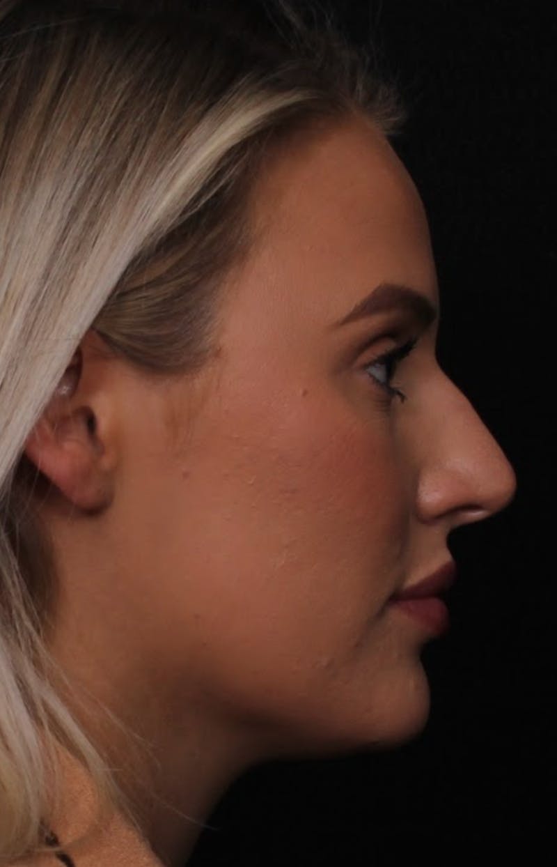 Rhinoplasty Female Before & After Gallery - Patient 194684 - Image 5