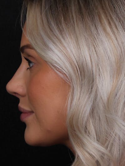 Rhinoplasty Female Before & After Gallery - Patient 194684 - Image 2