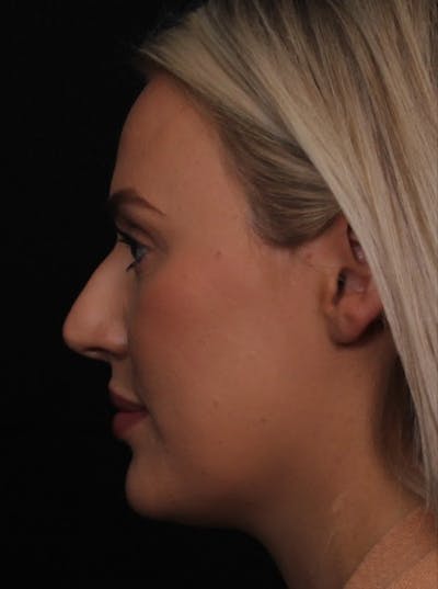 Rhinoplasty Female Before & After Gallery - Patient 194684 - Image 1