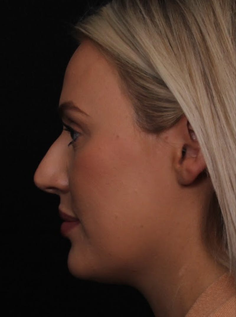 Rhinoplasty Female Before & After Gallery - Patient 194684 - Image 1