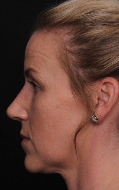 Rhinoplasty Female Before & After Gallery - Patient 325581 - Image 2