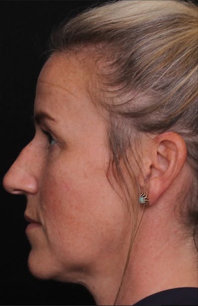 Rhinoplasty Female Before & After Gallery - Patient 325581 - Image 1