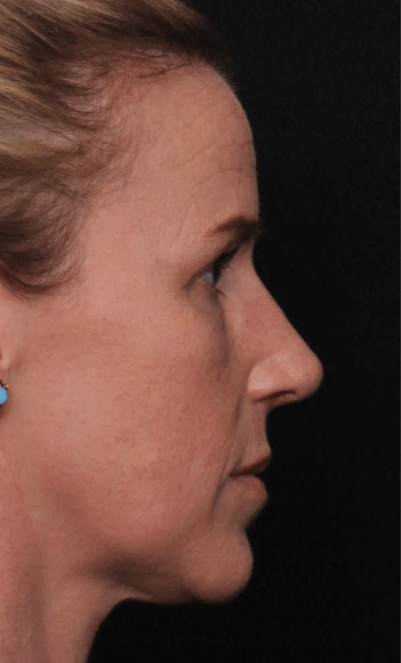 Rhinoplasty Female Before & After Gallery - Patient 325581 - Image 6