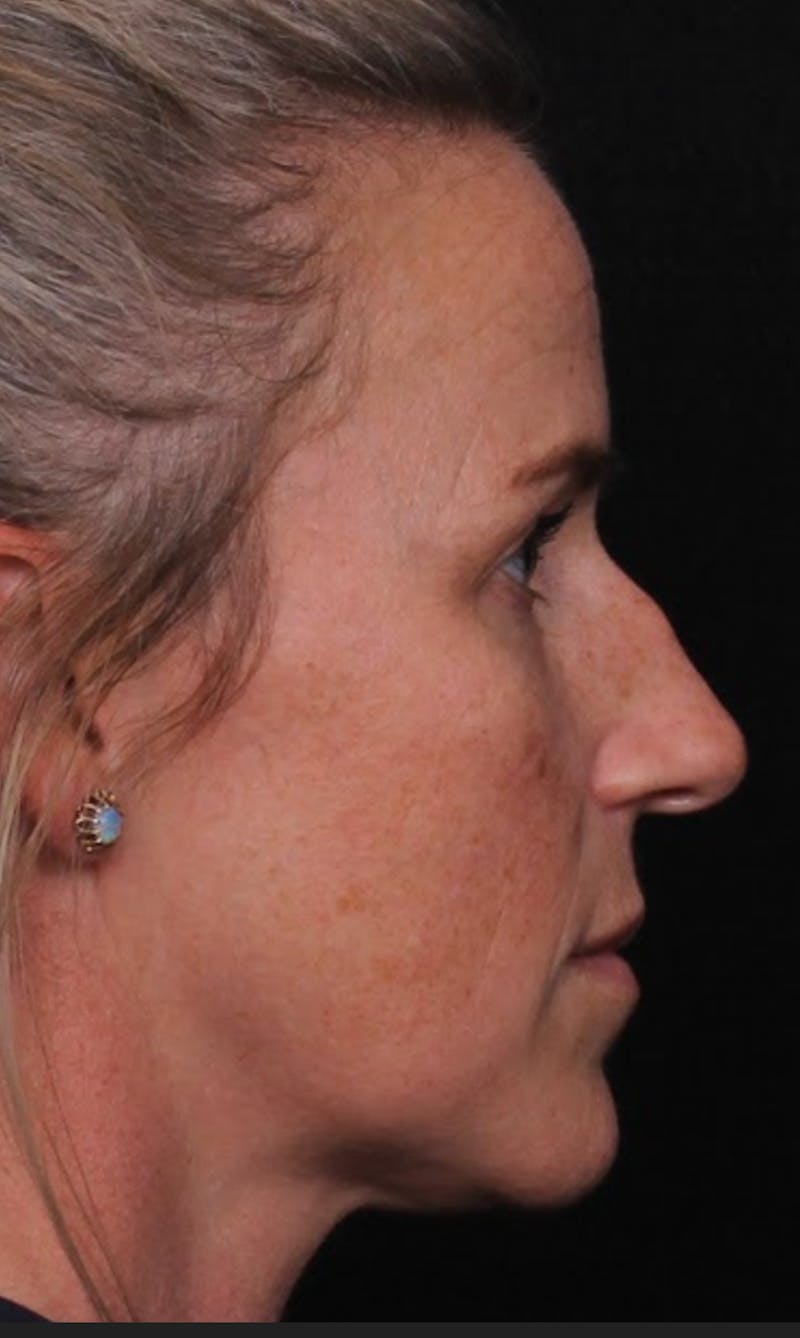 Rhinoplasty Female Before & After Gallery - Patient 325581 - Image 5