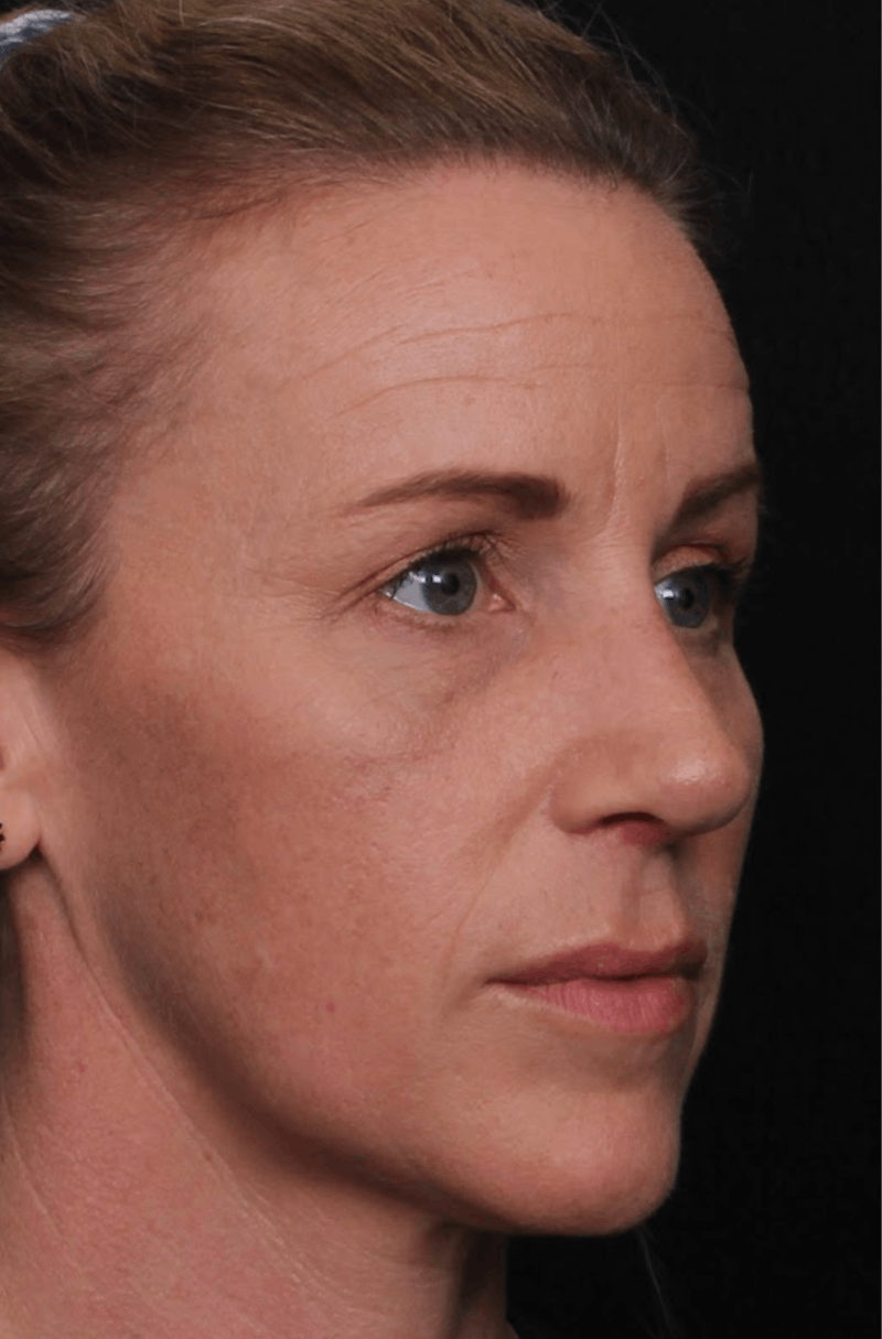 Rhinoplasty Female Before & After Gallery - Patient 325581 - Image 8