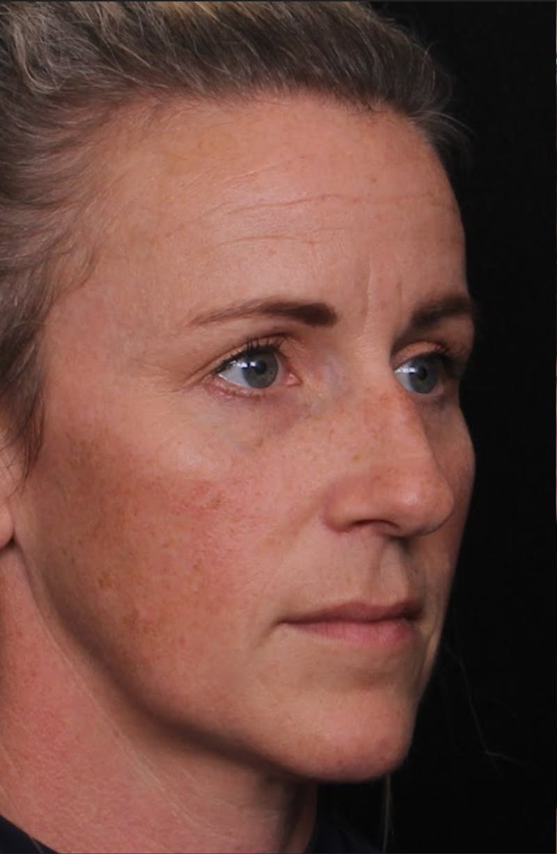 Rhinoplasty Female Before & After Gallery - Patient 325581 - Image 7