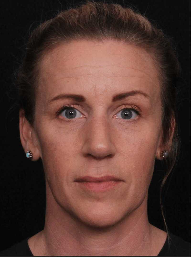 Rhinoplasty Female Before & After Gallery - Patient 325581 - Image 4