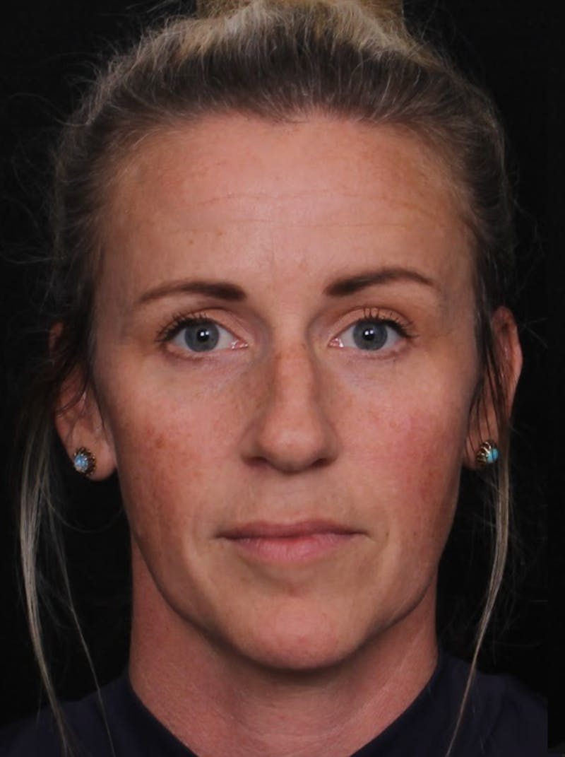 Rhinoplasty Female Before & After Gallery - Patient 325581 - Image 3