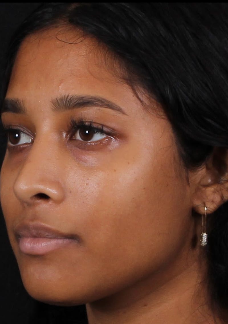 Rhinoplasty Female Before & After Gallery - Patient 362937 - Image 6