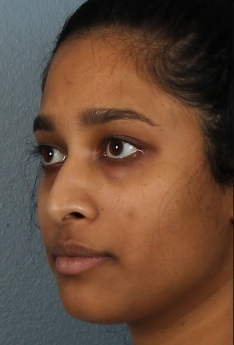 Rhinoplasty Female Before & After Gallery - Patient 362937 - Image 5