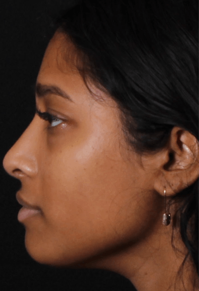 Rhinoplasty Female Before & After Gallery - Patient 362937 - Image 2