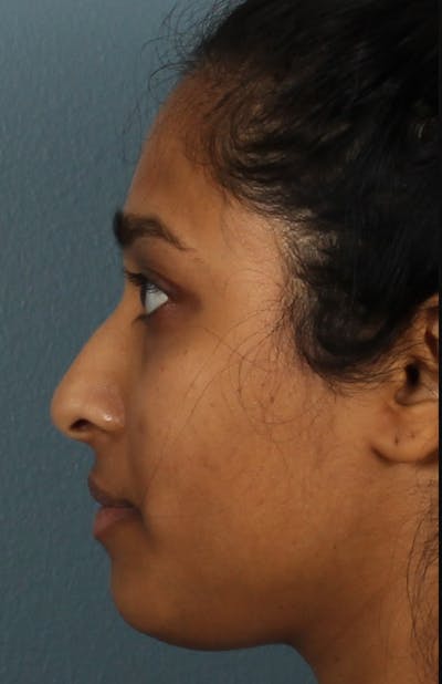 Rhinoplasty Female Before & After Gallery - Patient 362937 - Image 1