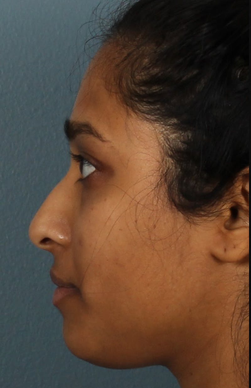 Rhinoplasty Female Before & After Gallery - Patient 362937 - Image 1