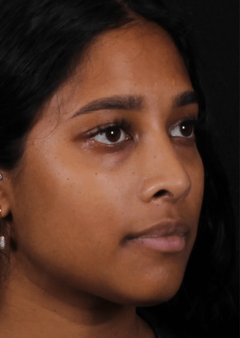 Rhinoplasty Female Before & After Gallery - Patient 362937 - Image 8