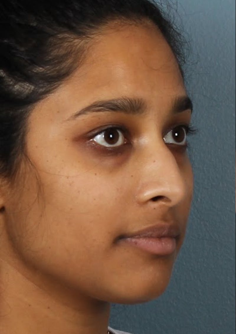 Rhinoplasty Female Before & After Gallery - Patient 362937 - Image 7