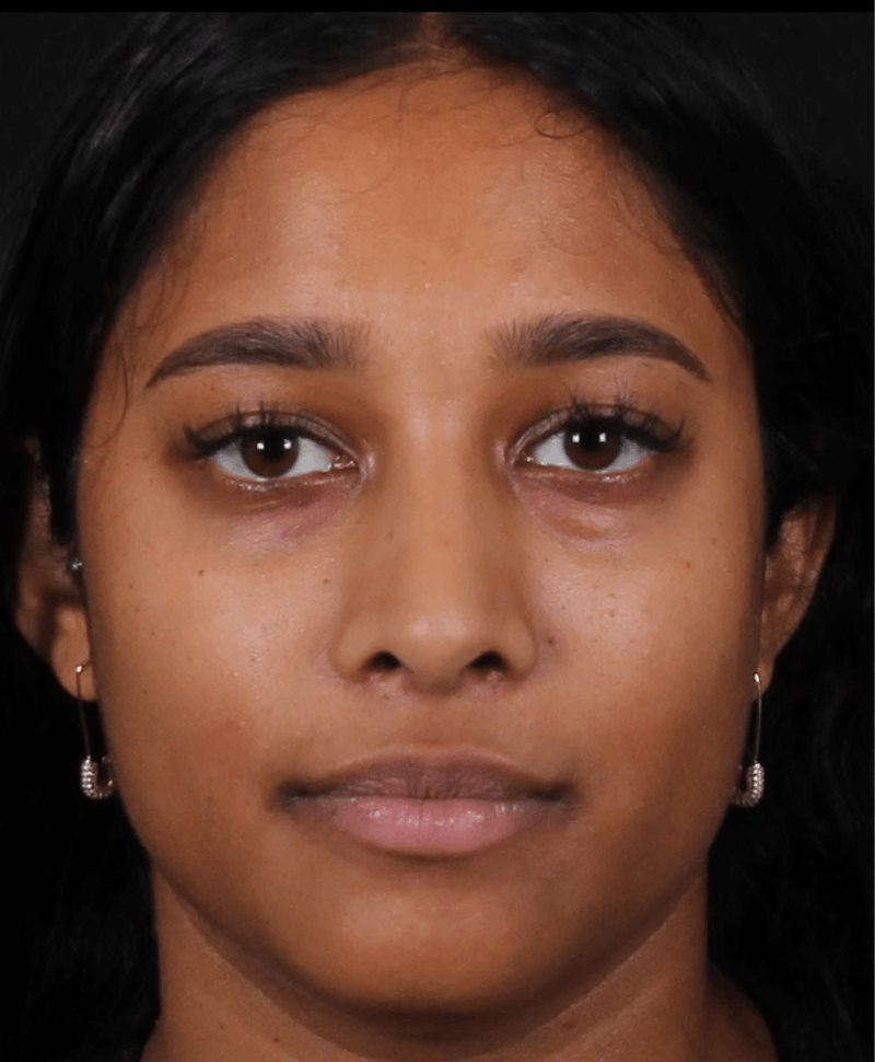 Rhinoplasty Female Before & After Gallery - Patient 362937 - Image 4