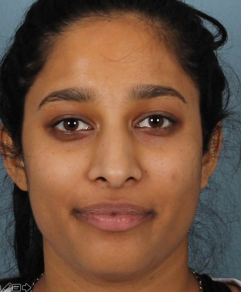 Rhinoplasty Female Before & After Gallery - Patient 362937 - Image 3