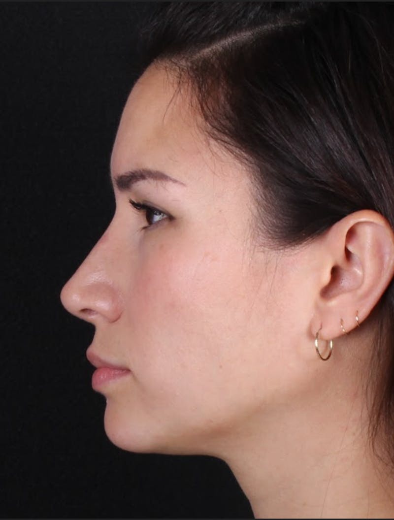 Rhinoplasty Female Before & After Gallery - Patient 369332 - Image 2