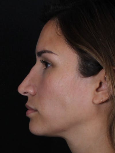 Rhinoplasty Female Before & After Gallery - Patient 369332 - Image 1