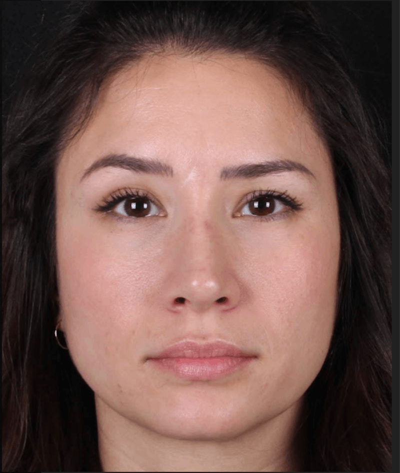 Rhinoplasty Female Before & After Gallery - Patient 369332 - Image 4
