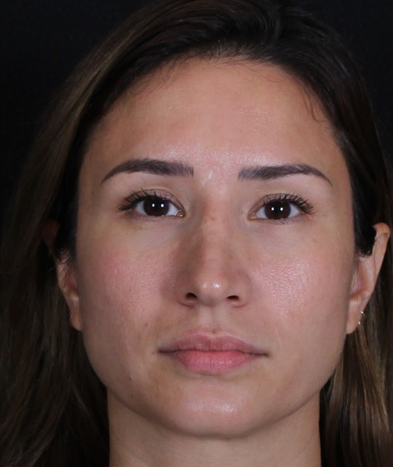 Rhinoplasty Female Before & After Gallery - Patient 369332 - Image 3