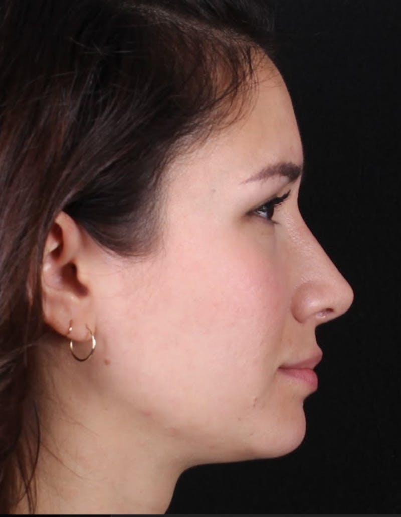 Rhinoplasty Female Before & After Gallery - Patient 369332 - Image 6