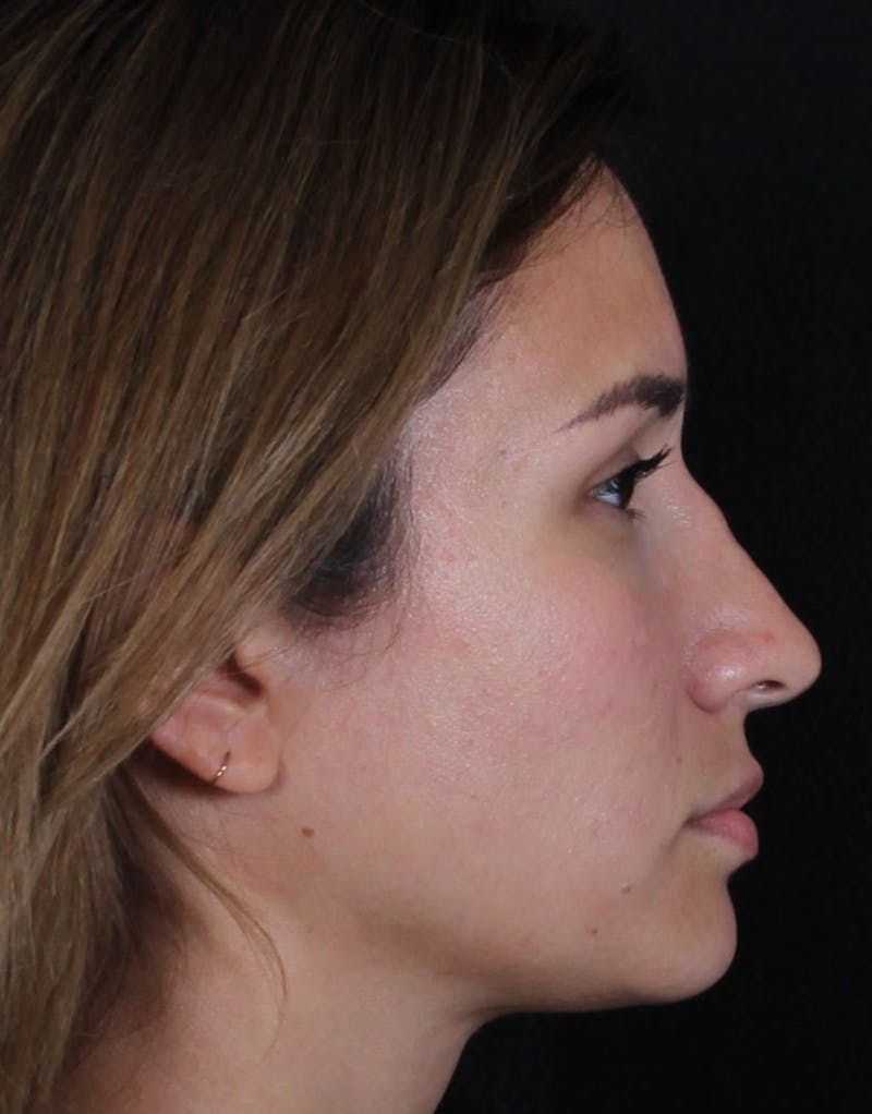 Rhinoplasty Female Before & After Gallery - Patient 369332 - Image 5