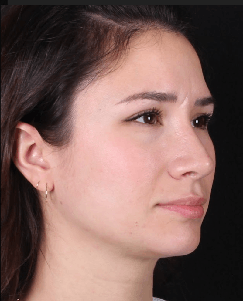 Rhinoplasty Female Before & After Gallery - Patient 369332 - Image 8
