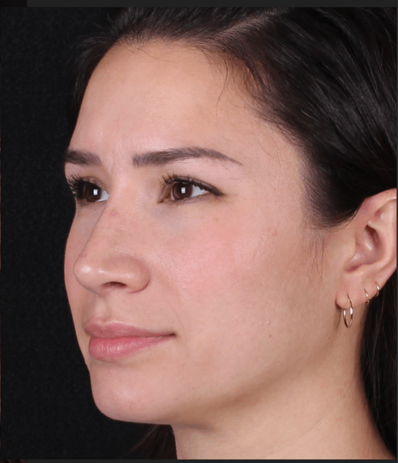 Rhinoplasty Female Before & After Gallery - Patient 369332 - Image 10
