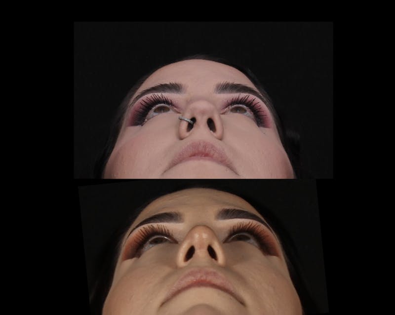 Rhinoplasty Female Before & After Gallery - Patient 217789 - Image 12