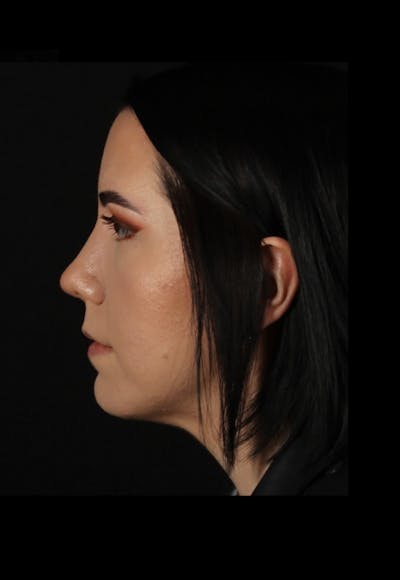 Rhinoplasty Female Before & After Gallery - Patient 217789 - Image 2