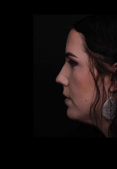 Rhinoplasty Female Before & After Gallery - Patient 217789 - Image 1