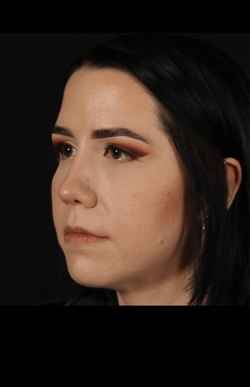 Rhinoplasty Female Before & After Gallery - Patient 217789 - Image 8