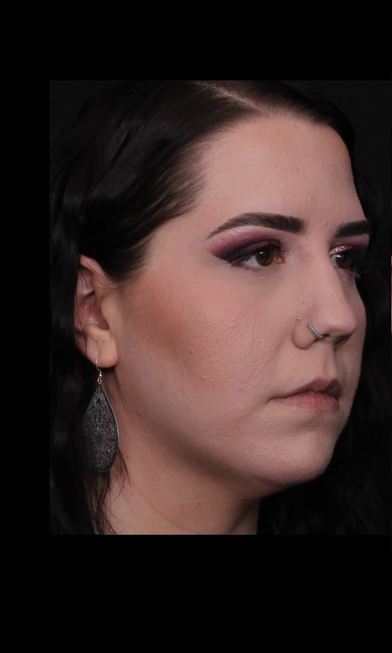 Rhinoplasty Female Before & After Gallery - Patient 217789 - Image 9