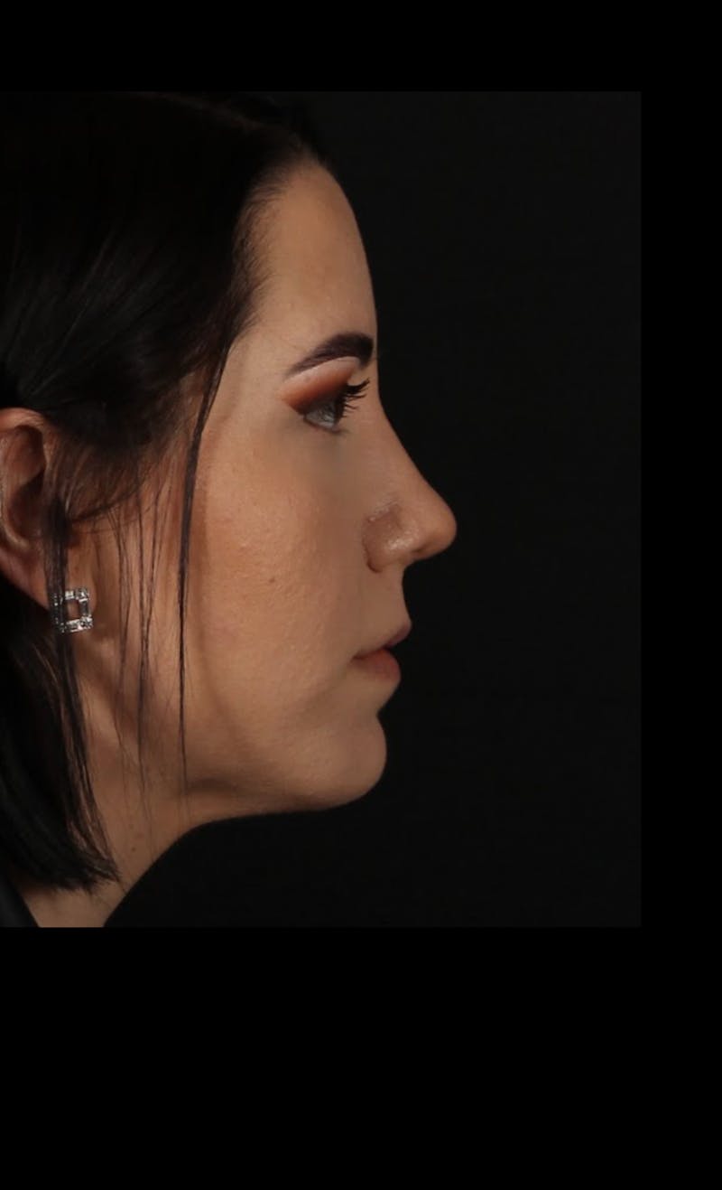 Rhinoplasty Female Before & After Gallery - Patient 217789 - Image 6
