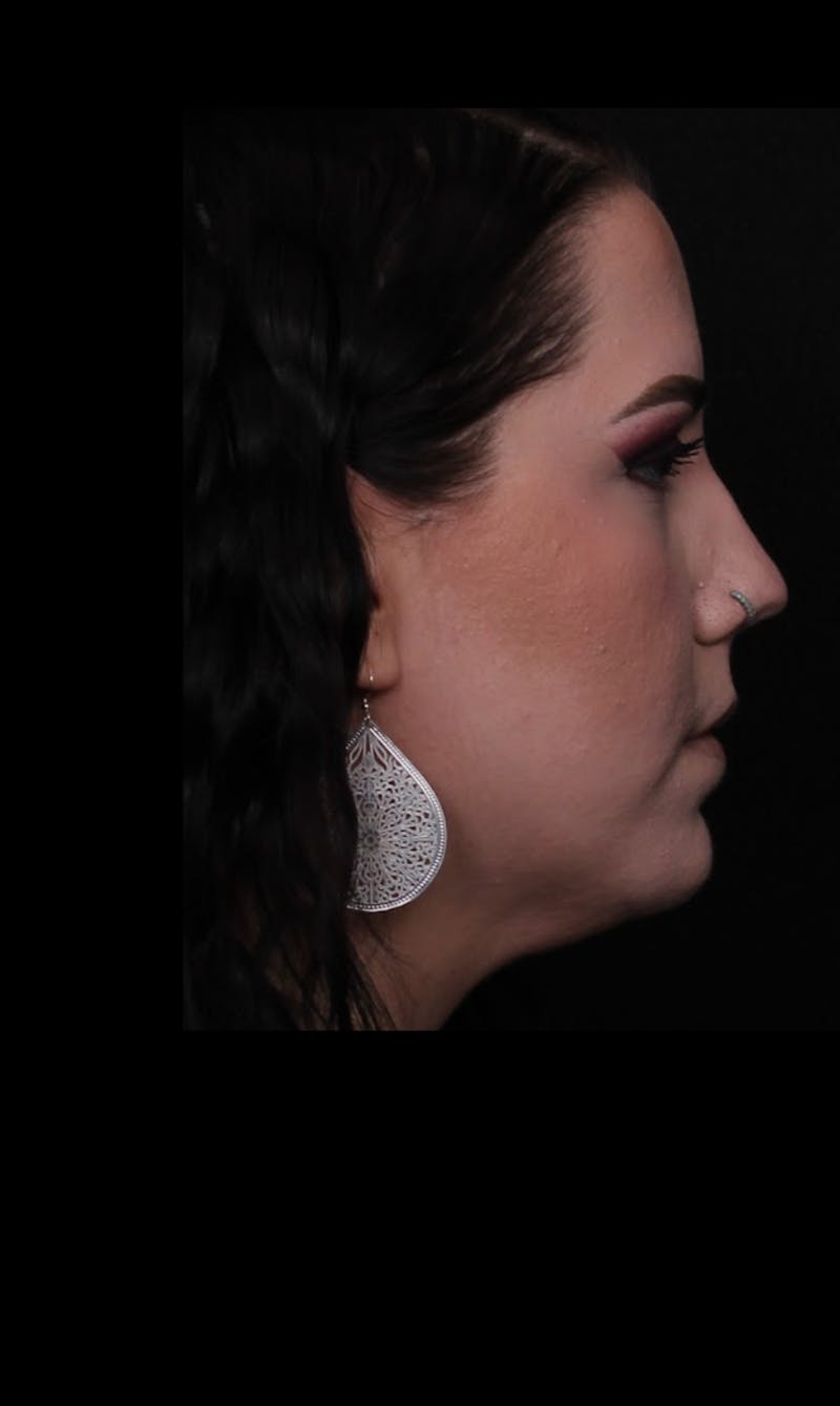 Rhinoplasty Female Before & After Gallery - Patient 217789 - Image 5