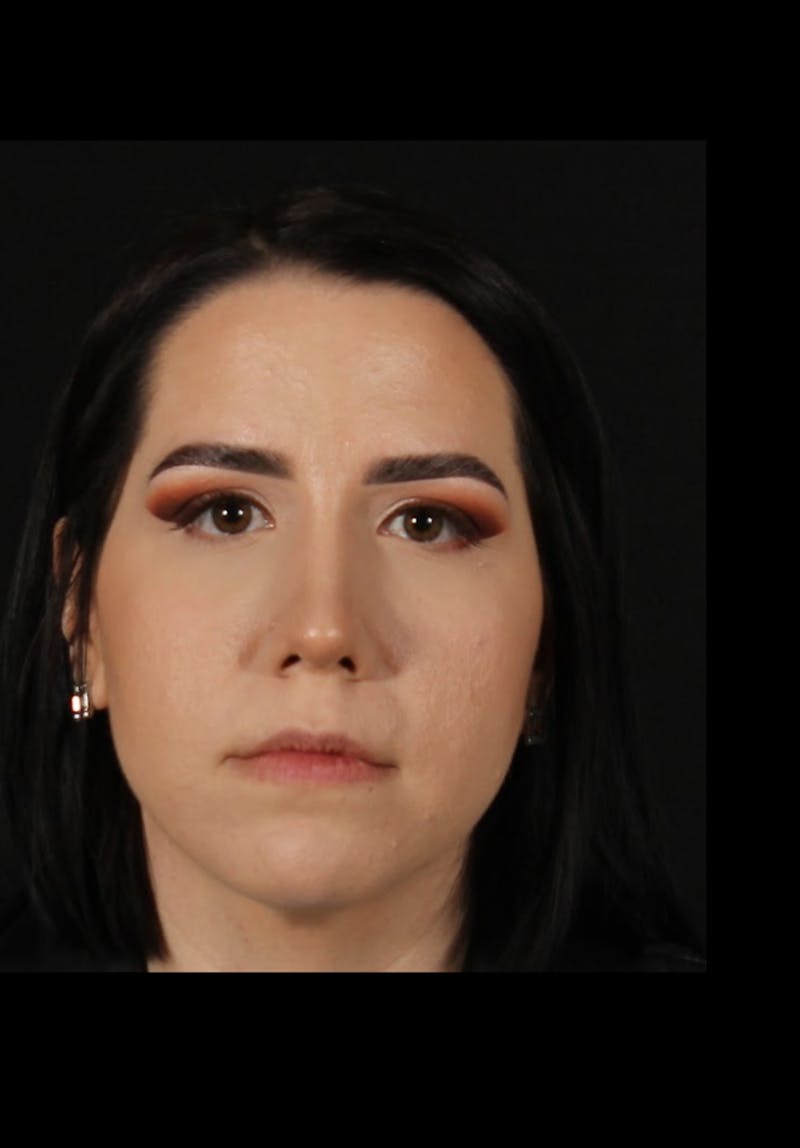 Rhinoplasty Female Before & After Gallery - Patient 217789 - Image 4