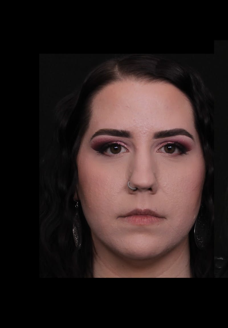 Rhinoplasty Female Before & After Gallery - Patient 217789 - Image 3