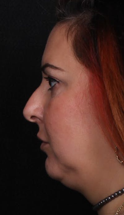 Rhinoplasty Female Before & After Gallery - Patient 715552 - Image 1