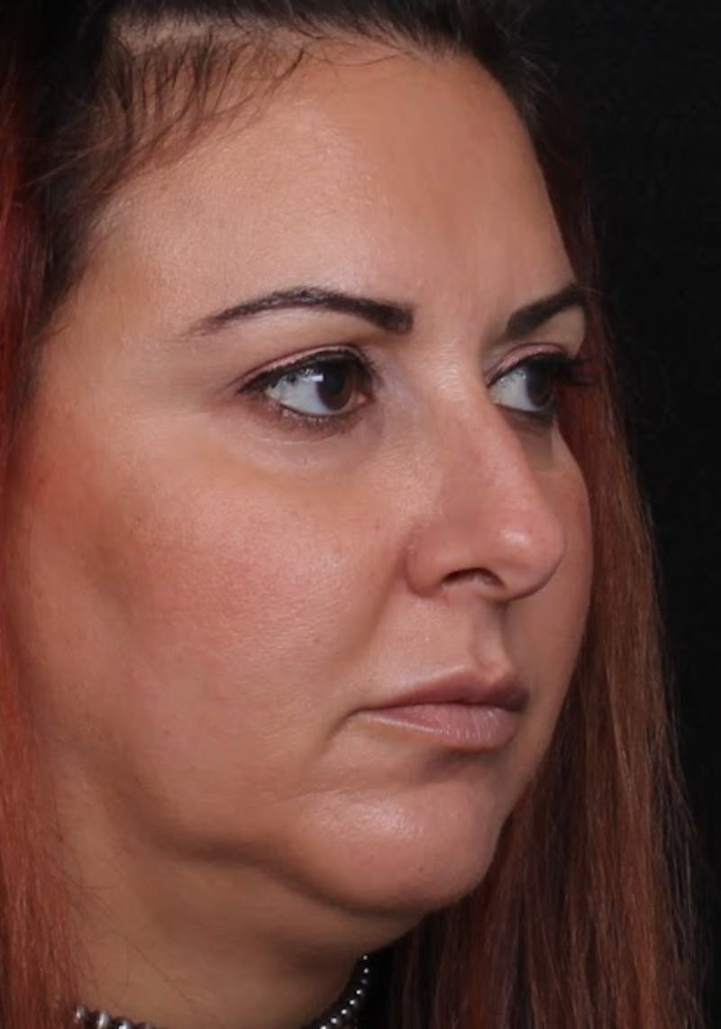 Rhinoplasty Female Before & After Gallery - Patient 715552 - Image 5