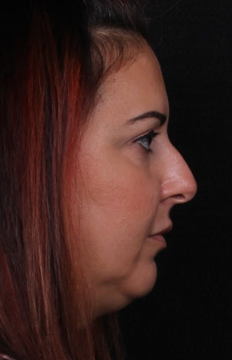 Rhinoplasty Female Before & After Gallery - Patient 715552 - Image 7