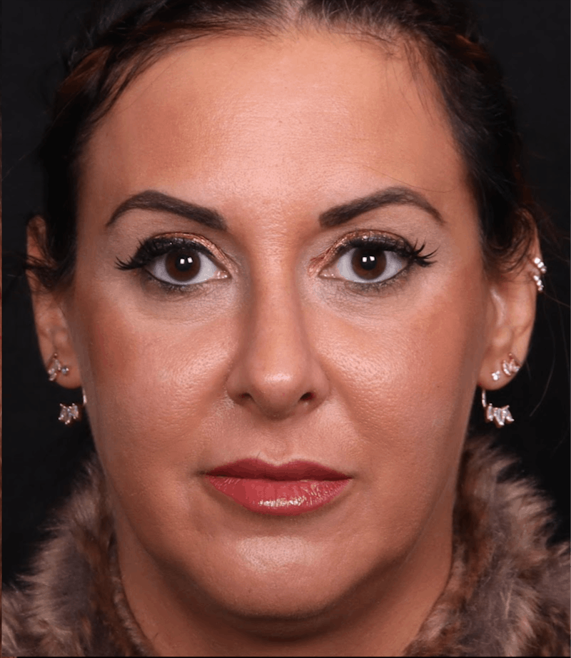 Rhinoplasty Female Before & After Gallery - Patient 715552 - Image 4