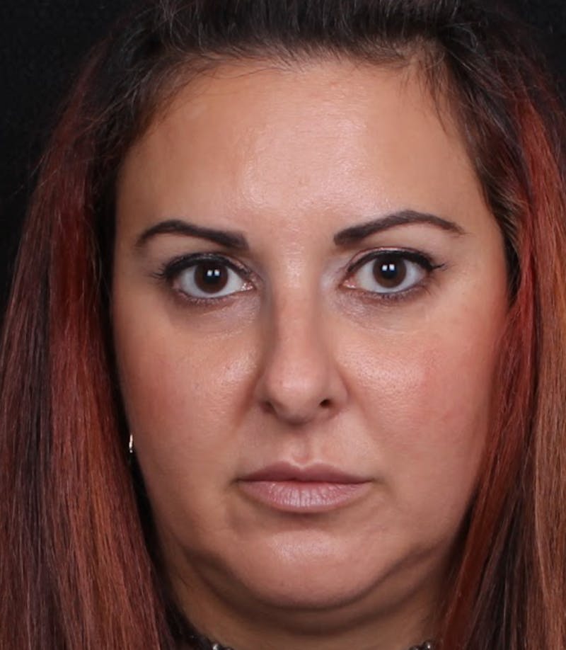 Rhinoplasty Female Before & After Gallery - Patient 715552 - Image 3