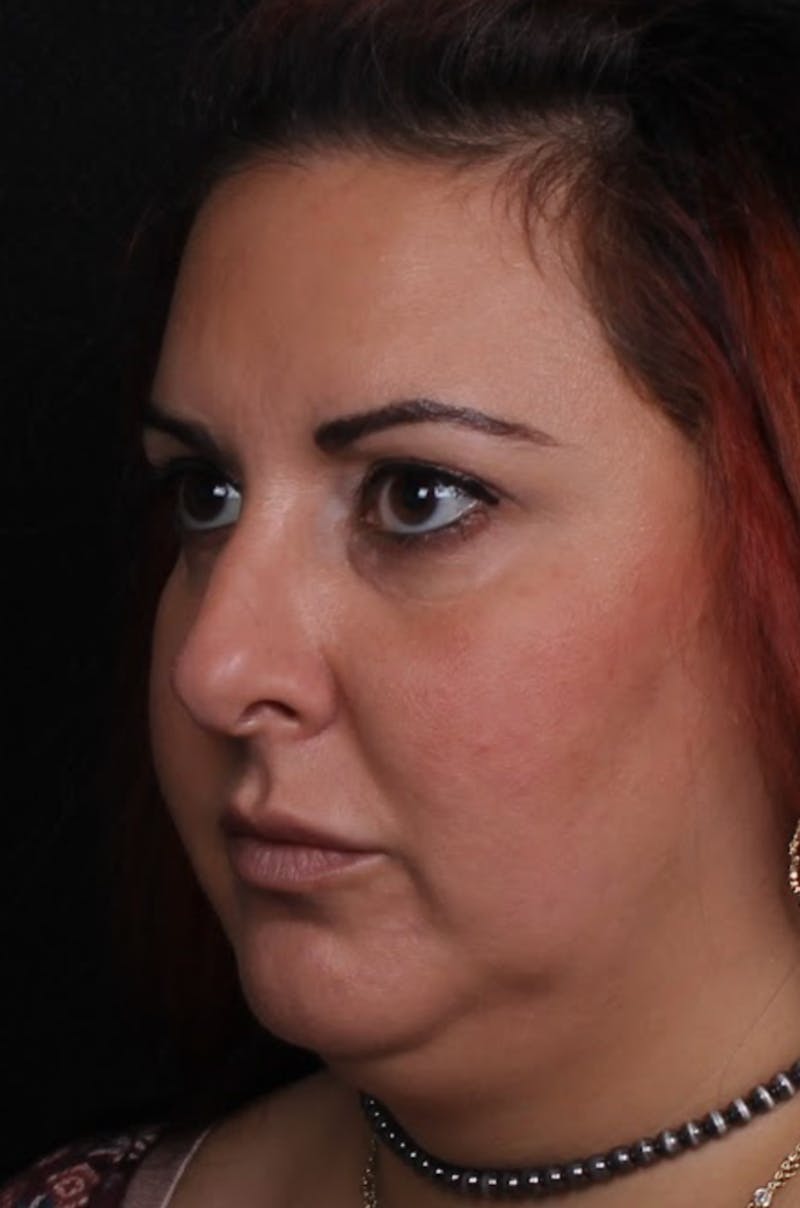 Rhinoplasty Female Before & After Gallery - Patient 715552 - Image 9