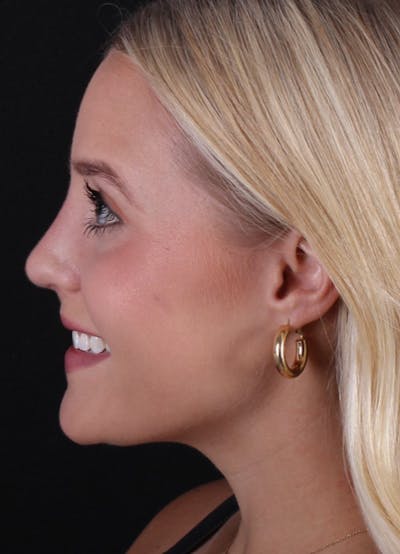 Rhinoplasty Female Before & After Gallery - Patient 428250 - Image 2