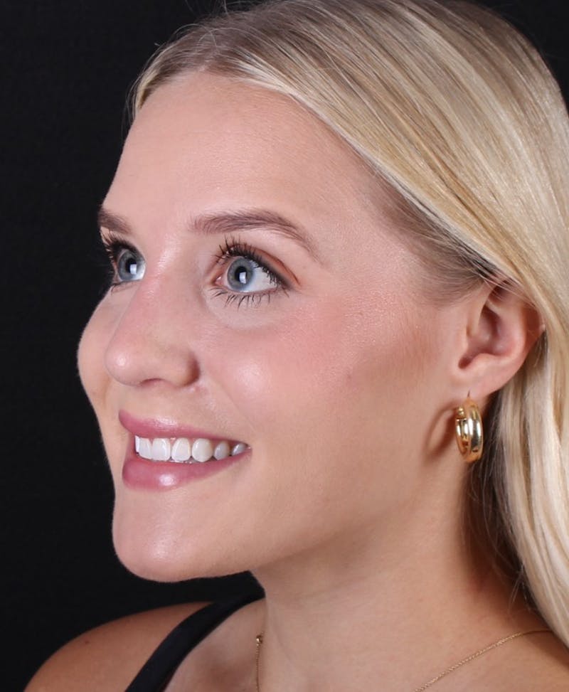 Rhinoplasty Female Before & After Gallery - Patient 428250 - Image 6