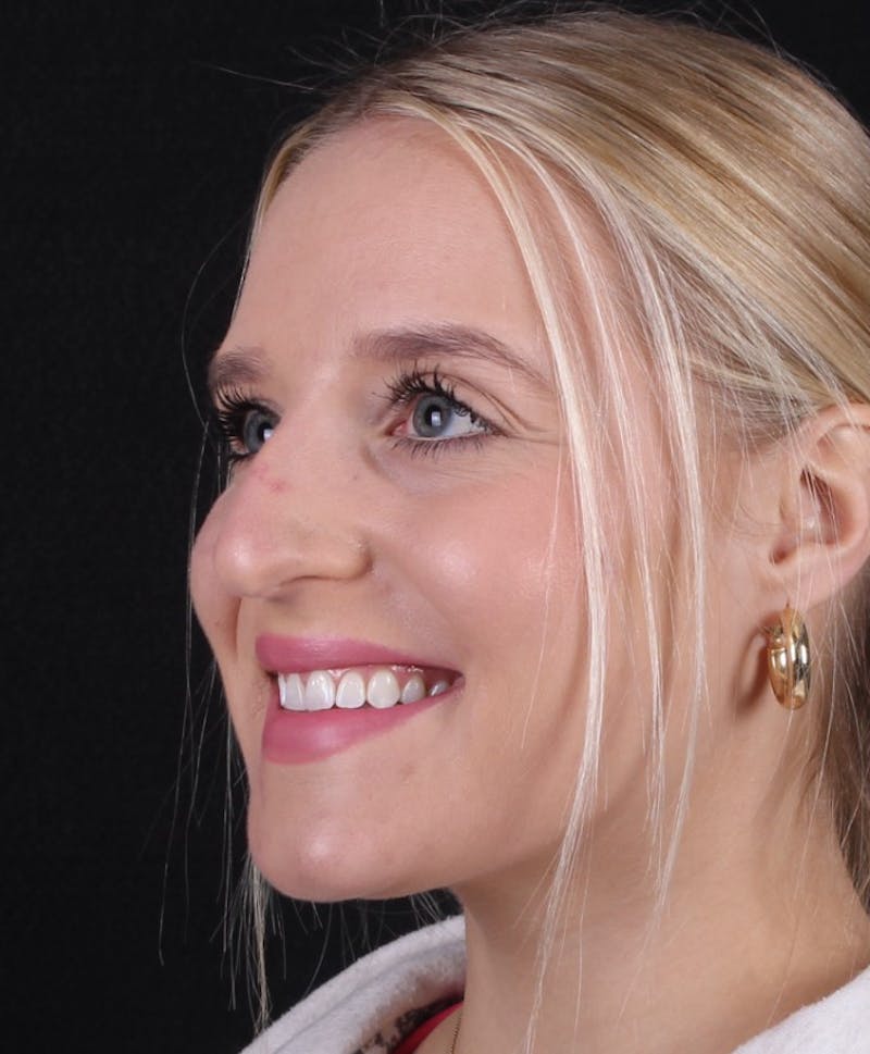 Rhinoplasty Female Before & After Gallery - Patient 428250 - Image 5
